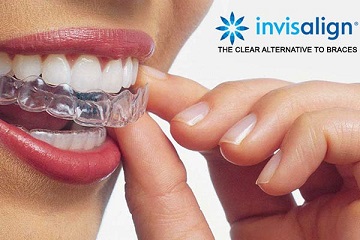 Invisalign Go