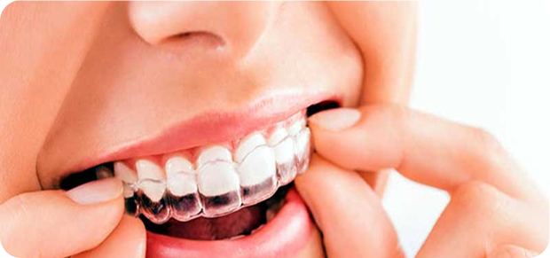 Clear Aligners